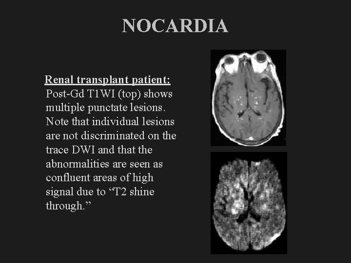 NOCARDIA Renal transplant patient: Post-Gd T 1 WI (top) shows multiple punctate lesions. Note