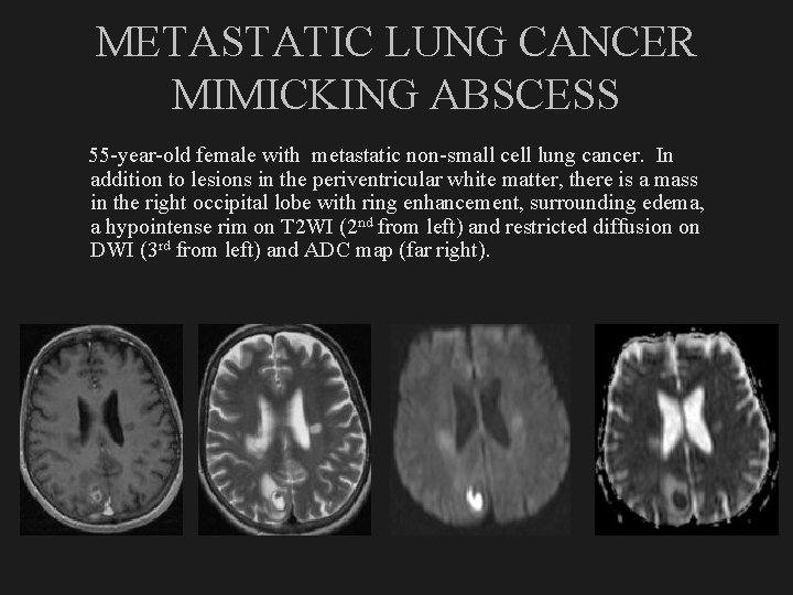 METASTATIC LUNG CANCER MIMICKING ABSCESS 55 -year-old female with metastatic non-small cell lung cancer.