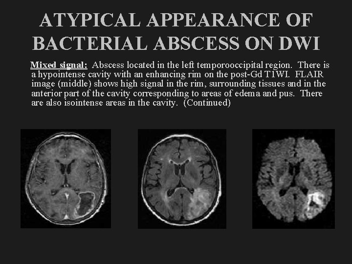 ATYPICAL APPEARANCE OF BACTERIAL ABSCESS ON DWI Mixed signal: Abscess located in the left