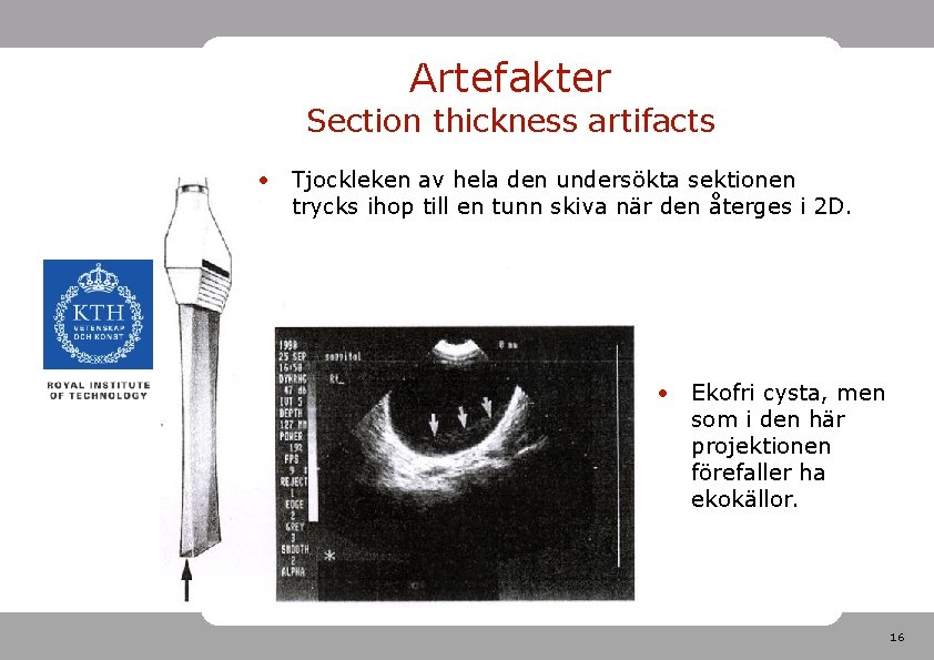 Artefakter Section thickness artifacts • Tjockleken av hela den undersökta sektionen trycks ihop till Artefakter Section thickness artifacts • Tjockleken av hela den undersökta sektionen trycks ihop till