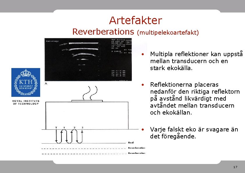 Artefakter Reverberations (multipelekoartefakt) • Multipla reflektioner kan uppstå mellan transducern och en stark ekokälla.