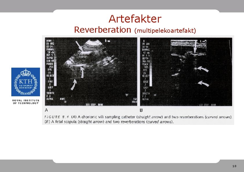 Artefakter Reverberation (multipelekoartefakt) 18 