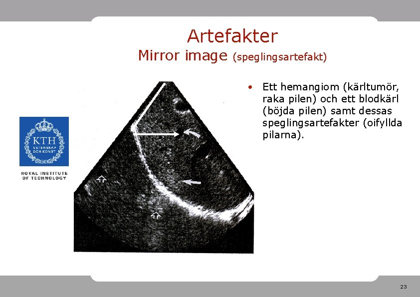 Artefakter Mirror image (speglingsartefakt) • Ett hemangiom (kärltumör, raka pilen) och ett blodkärl (böjda