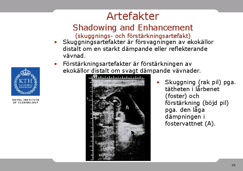 Artefakter Shadowing and Enhancement (skuggnings- och förstärkningsartefakt) • Skuggningsartefakter är försvagningen av ekokällor distalt