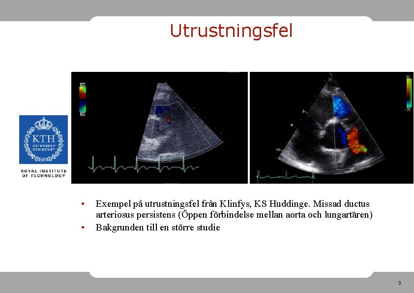 Utrustningsfel • • Exempel på utrustningsfel från Klinfys, KS Huddinge. Missad ductus arteriosus persistens