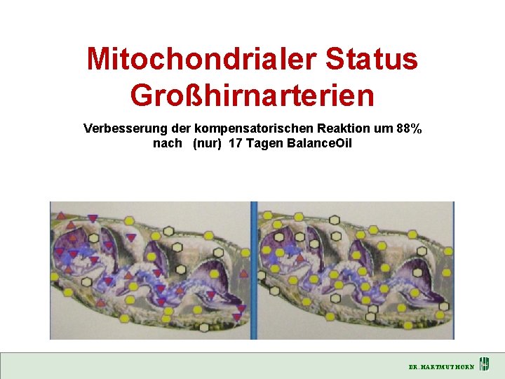 Mitochondrialer Status Großhirnarterien Verbesserung der kompensatorischen Reaktion um 88% nach (nur) 17 Tagen Balance.