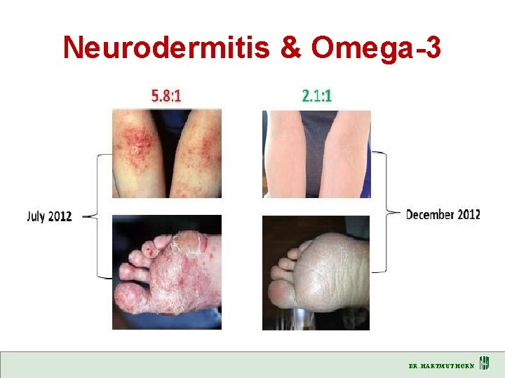 Neurodermitis & Omega-3 DR. HARTMUT HORN 