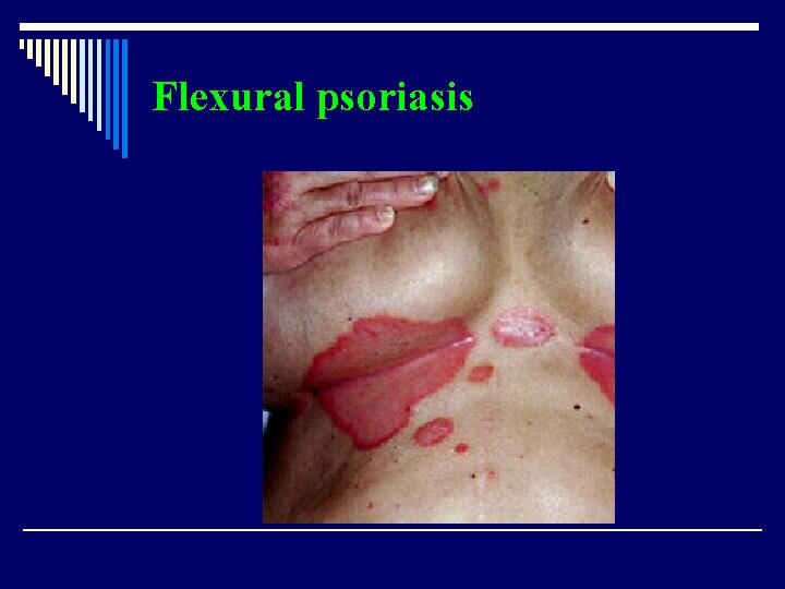 Flexural psoriasis 