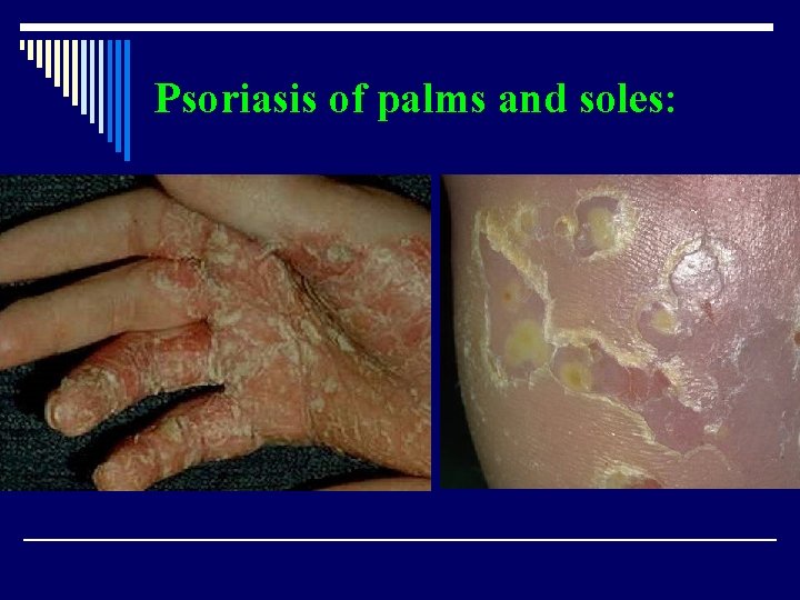 Psoriasis of palms and soles: 