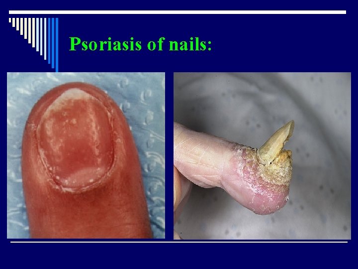 Psoriasis of nails: 