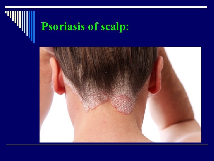 Psoriasis of scalp: 