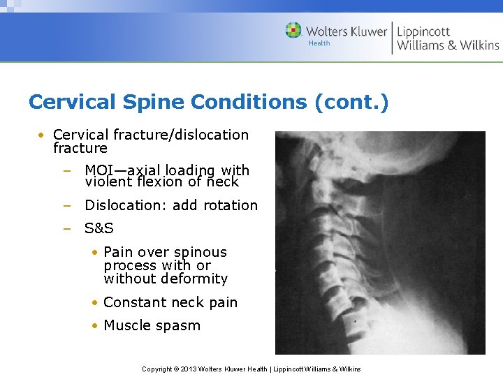Cervical Spine Conditions (cont. ) • Cervical fracture/dislocation fracture – MOI—axial loading with violent