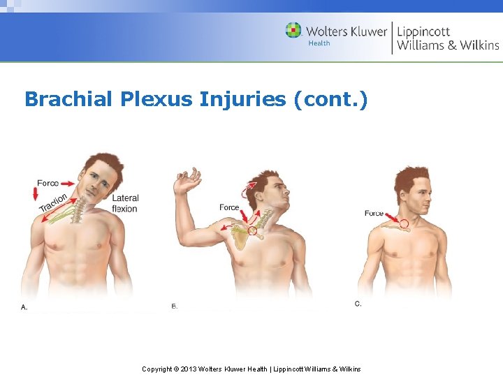 Brachial Plexus Injuries (cont. ) Copyright © 2013 Wolters Kluwer Health | Lippincott Williams