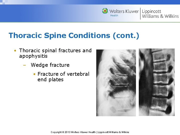 Thoracic Spine Conditions (cont. ) • Thoracic spinal fractures and apophysitis – Wedge fracture