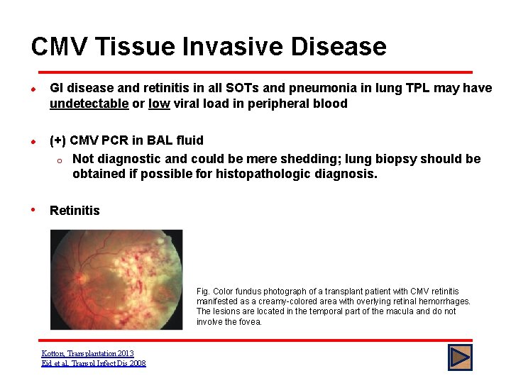 CMV Tissue Invasive Disease l l GI disease and retinitis in all SOTs and