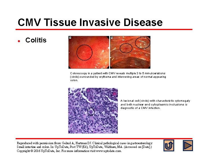 CMV Tissue Invasive Disease l Colitis Colonoscopy in a patient with CMV reveals multiple