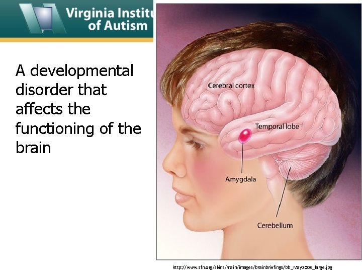 A developmental disorder that affects the functioning of the brain http: //www. sfn. org/skins/main/images/brainbriefings/bb_May