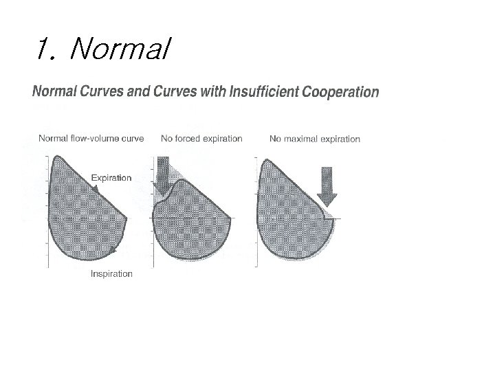 1. Normal 1. Normal