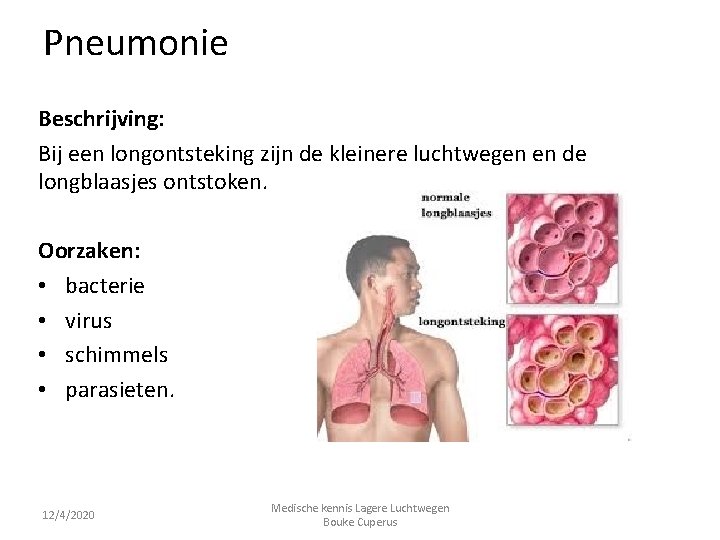 Pneumonie Beschrijving: Bij een longontsteking zijn de kleinere luchtwegen en de longblaasjes ontstoken. Oorzaken: