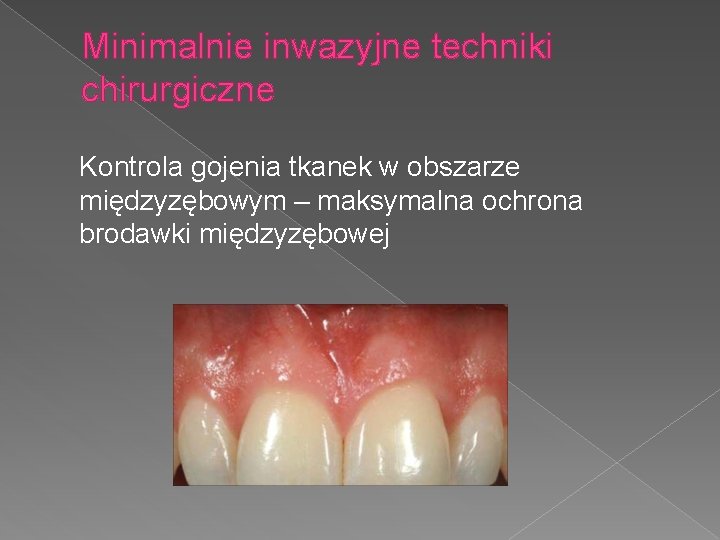 Minimalnie inwazyjne techniki chirurgiczne Kontrola gojenia tkanek w obszarze międzyzębowym – maksymalna ochrona brodawki