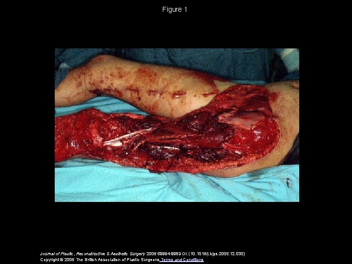Figure 1 Journal of Plastic, Reconstructive & Aesthetic Surgery 2006 59994 -998 DOI: (10.