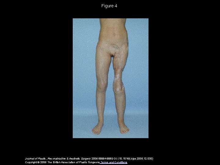 Figure 4 Journal of Plastic, Reconstructive & Aesthetic Surgery 2006 59994 -998 DOI: (10.