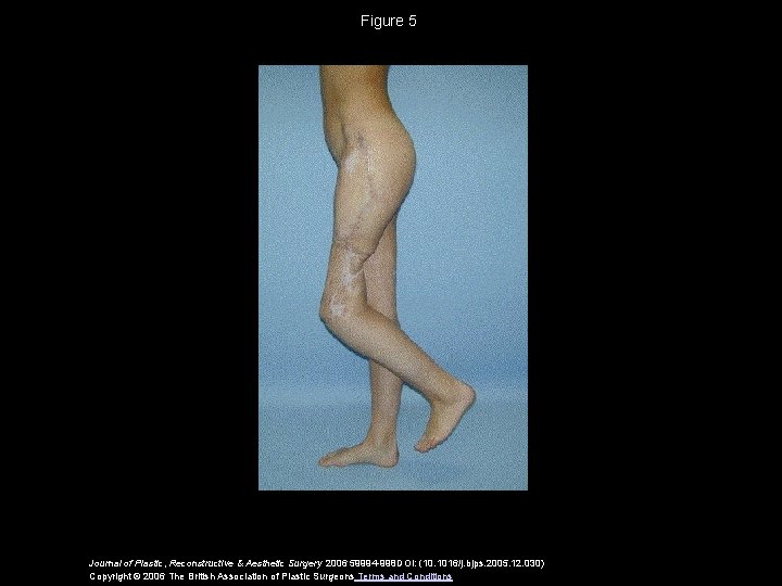 Figure 5 Journal of Plastic, Reconstructive & Aesthetic Surgery 2006 59994 -998 DOI: (10.