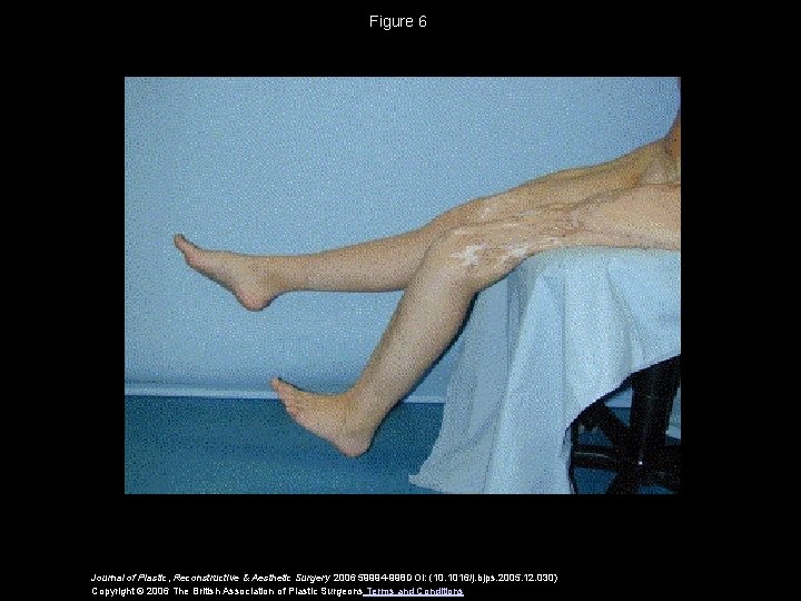 Figure 6 Journal of Plastic, Reconstructive & Aesthetic Surgery 2006 59994 -998 DOI: (10.