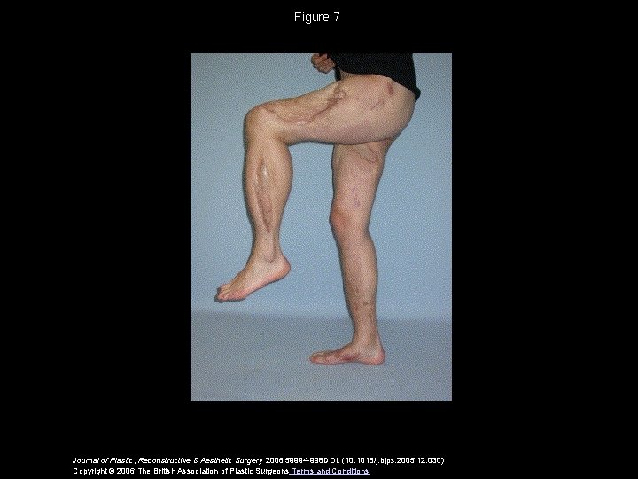 Figure 7 Journal of Plastic, Reconstructive & Aesthetic Surgery 2006 59994 -998 DOI: (10.