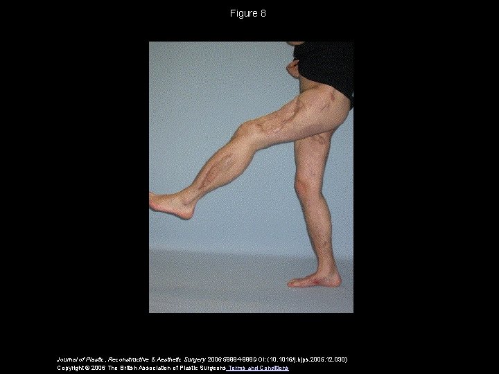 Figure 8 Journal of Plastic, Reconstructive & Aesthetic Surgery 2006 59994 -998 DOI: (10.