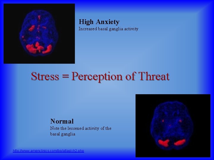 High Anxiety Increased basal ganglia activity Stress = Perception of Threat Normal Note the