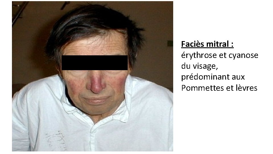  Faciès mitral : érythrose et cyanose du visage, prédominant aux Pommettes et lèvres