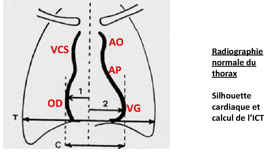 VCS AO Radiographie normale du thorax AP OD VG Silhouette cardiaque et calcul de
