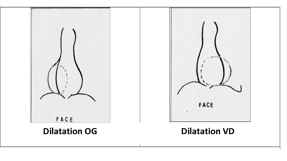  Dilatation OG Dilatation VD 