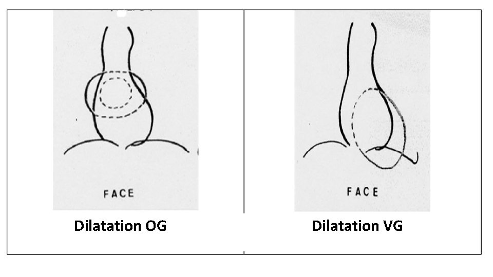 Dilatation VG Dilatation OG 