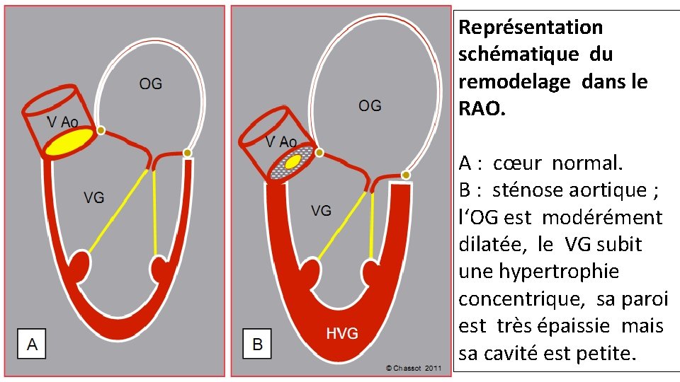 Représentation schématique du remodelage dans le RAO. A : cœur normal. B : sténose