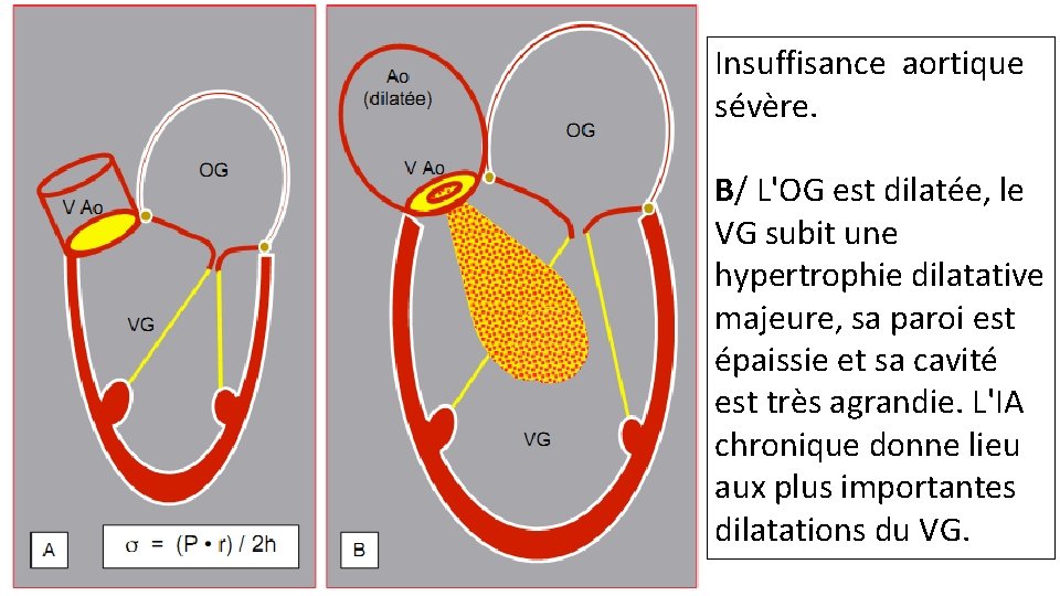 Insuffisance aortique sévère. B/ L'OG est dilatée, le VG subit une hypertrophie dilatative majeure,