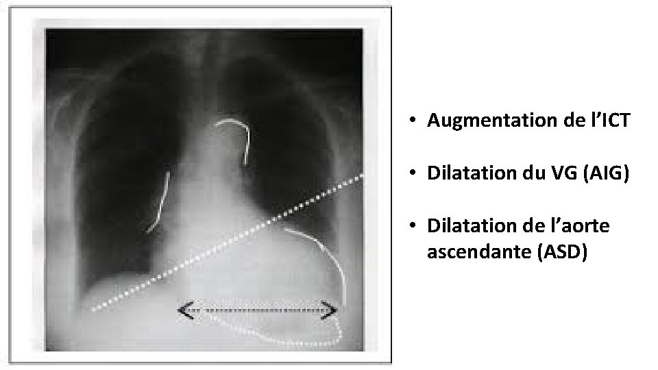  • Augmentation de l’ICT • Dilatation du VG (AIG) • Dilatation de l’aorte