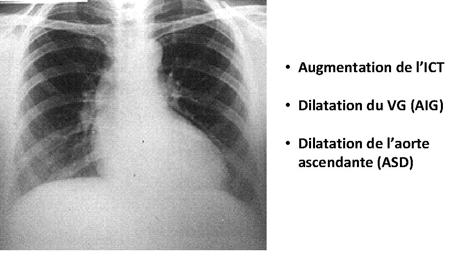  • Augmentation de l’ICT • Dilatation du VG (AIG) • Dilatation de l’aorte