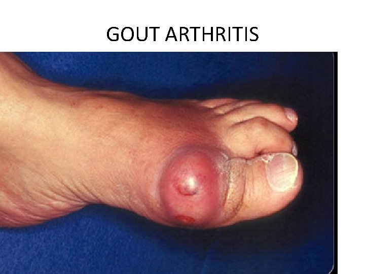 GOUT ARTHRITIS 