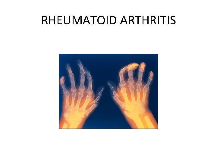 RHEUMATOID ARTHRITIS 