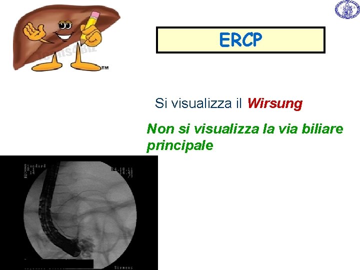 ERCP Si visualizza il Wirsung Non si visualizza la via biliare principale ERCP Si visualizza il Wirsung Non si visualizza la via biliare principale