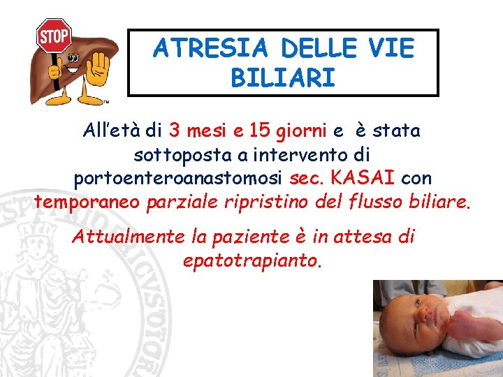 ATRESIA DELLE VIE BILIARI All’età di 3 mesi e 15 giorni e è stata ATRESIA DELLE VIE BILIARI All’età di 3 mesi e 15 giorni e è stata
