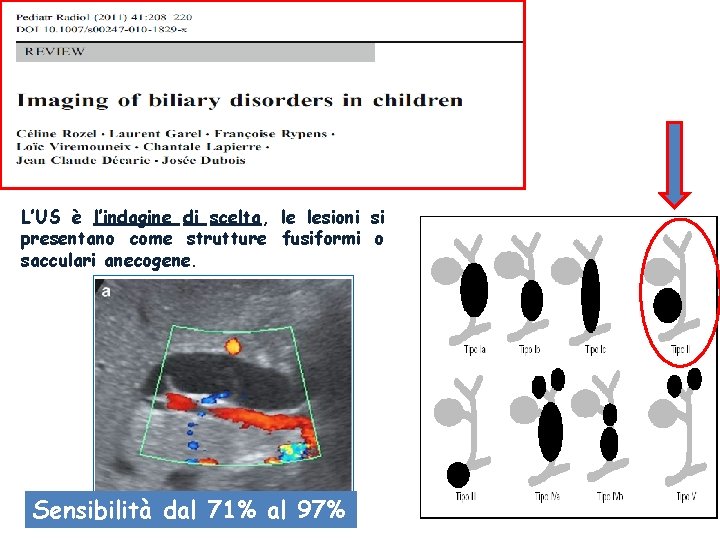 L’US è l’indagine di scelta, le lesioni si presentano come strutture fusiformi o sacculari L’US è l’indagine di scelta, le lesioni si presentano come strutture fusiformi o sacculari