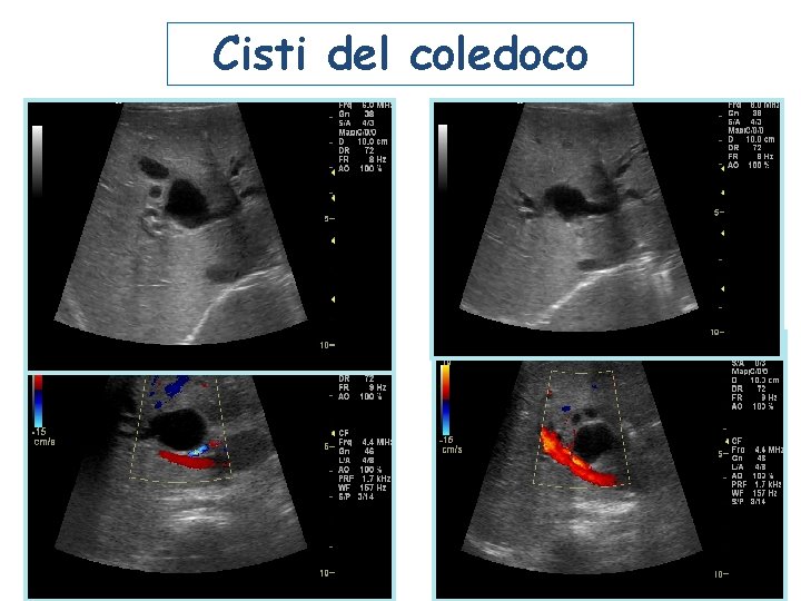 Cisti del coledoco Cisti del coledoco