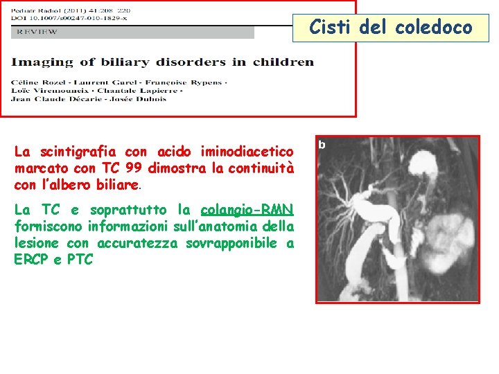 Cisti del coledoco La scintigrafia con acido iminodiacetico marcato con TC 99 dimostra la Cisti del coledoco La scintigrafia con acido iminodiacetico marcato con TC 99 dimostra la