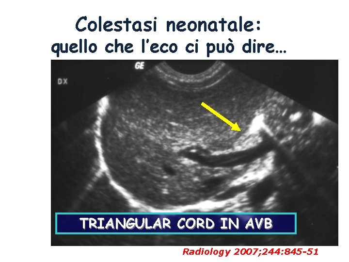 Colestasi neonatale: quello che l’eco ci può dire… TRIANGULAR CORD IN AVB Radiology 2007; Colestasi neonatale: quello che l’eco ci può dire… TRIANGULAR CORD IN AVB Radiology 2007;