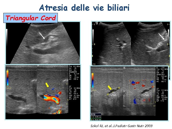 Atresia delle vie biliari Triangular Cord Sokol RJ, et al. J. Pediatr Gastr Nutr Atresia delle vie biliari Triangular Cord Sokol RJ, et al. J. Pediatr Gastr Nutr