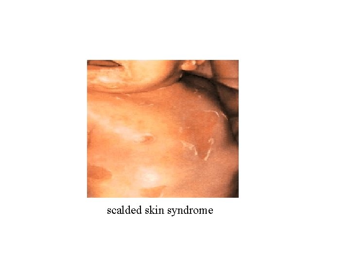 scalded skin syndrome scalded skin syndrome
