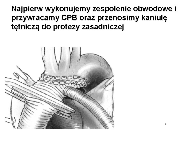 Najpierw wykonujemy zespolenie obwodowe i przywracamy CPB oraz przenosimy kaniulę tętniczą do protezy zasadniczej